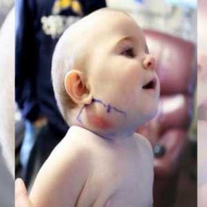 Uvećani limfni čvor na vratu djeteta. Uzroci i tretman
