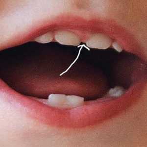 Bridle gornje usne: pravilo liječenje povreda