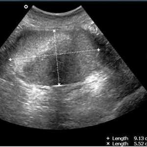 Ginekološki ultrazvuk kada učiniti: prije ili poslije menstruacije?