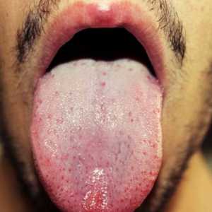 Saznajte šta je uzrok bijele mrlje na jeziku odraslih