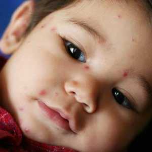Boginje u novorođenčadi. Simptomi i tok bolesti