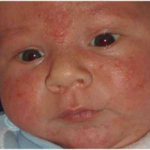 Vezikulopustulez kod novorođenčadi: patogena, simptomi i liječenje
