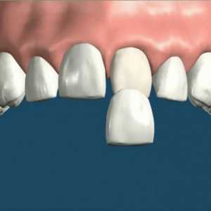 Furnir o prednostima zubima element, odlike njegova instalacija i indikacije za upotrebu