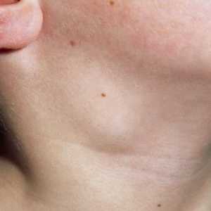 Otečene limfne čvorove na vratu djeteta: uzroci i tretman
