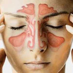 Upala sinusa, ili Što je sinusitis
