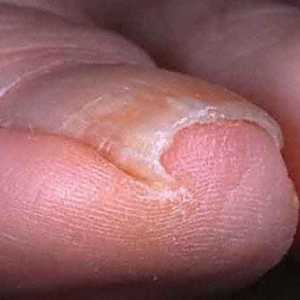 Urasta tretman noktiju i prevenciju