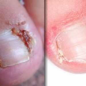 Urasta nokat na nozi: uzroci i liječenje