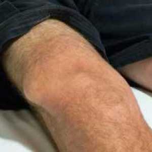 Dislokacija zgloba koljena: glavni simptomi, liječenje