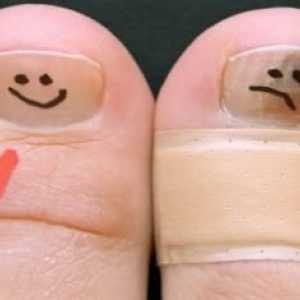 Nesretnih gljivica na nokte na nogama: tretman narodnih pravnih lijekova