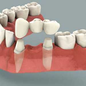 Zubni most: recenzije. Instalacija zubni most